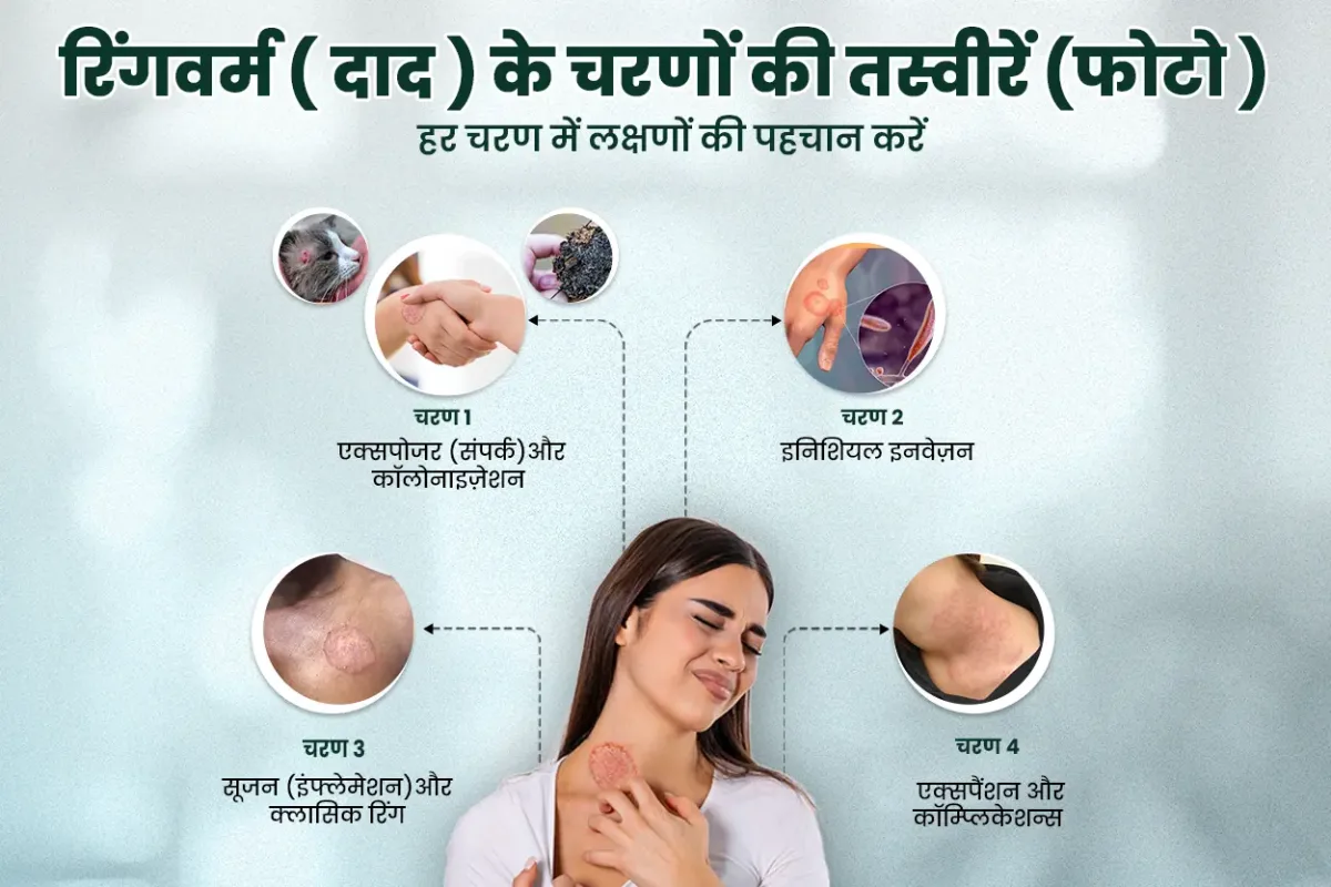 रिंगवर्म ( दाद ) के चरणों की तस्वीरें (फोटो ) &ndash; हर चरण में लक्षणों की पहचान करें