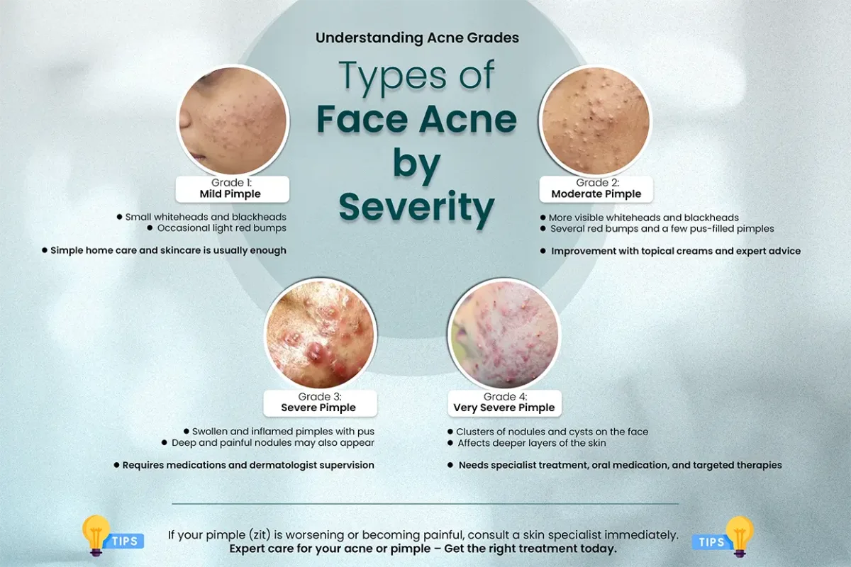 Types Of Face Acne Grades Based on Severity - Dermatologist Analysis 