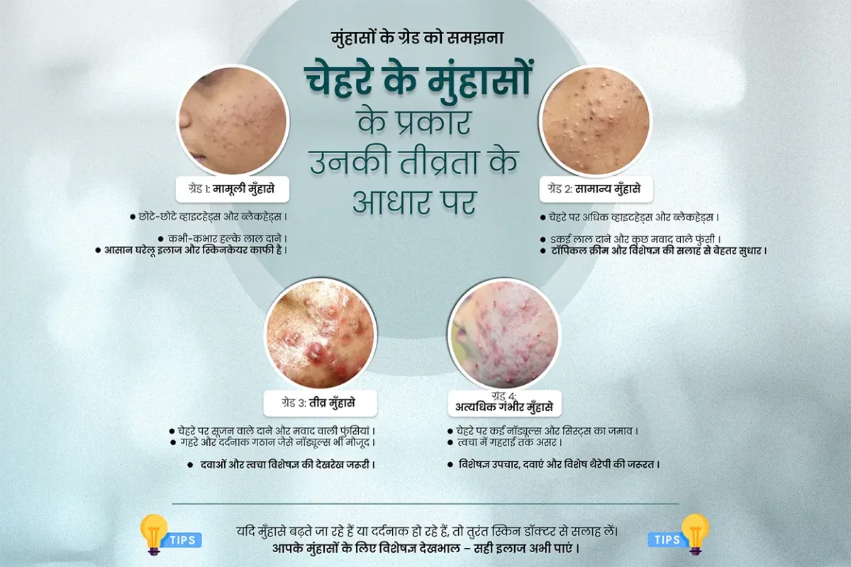 चेहरे के मुँहासों को गंभीरता के आधार पर कैसे आँकते हैं - त्वचा विशेषज्ञ  विश्लेषण 