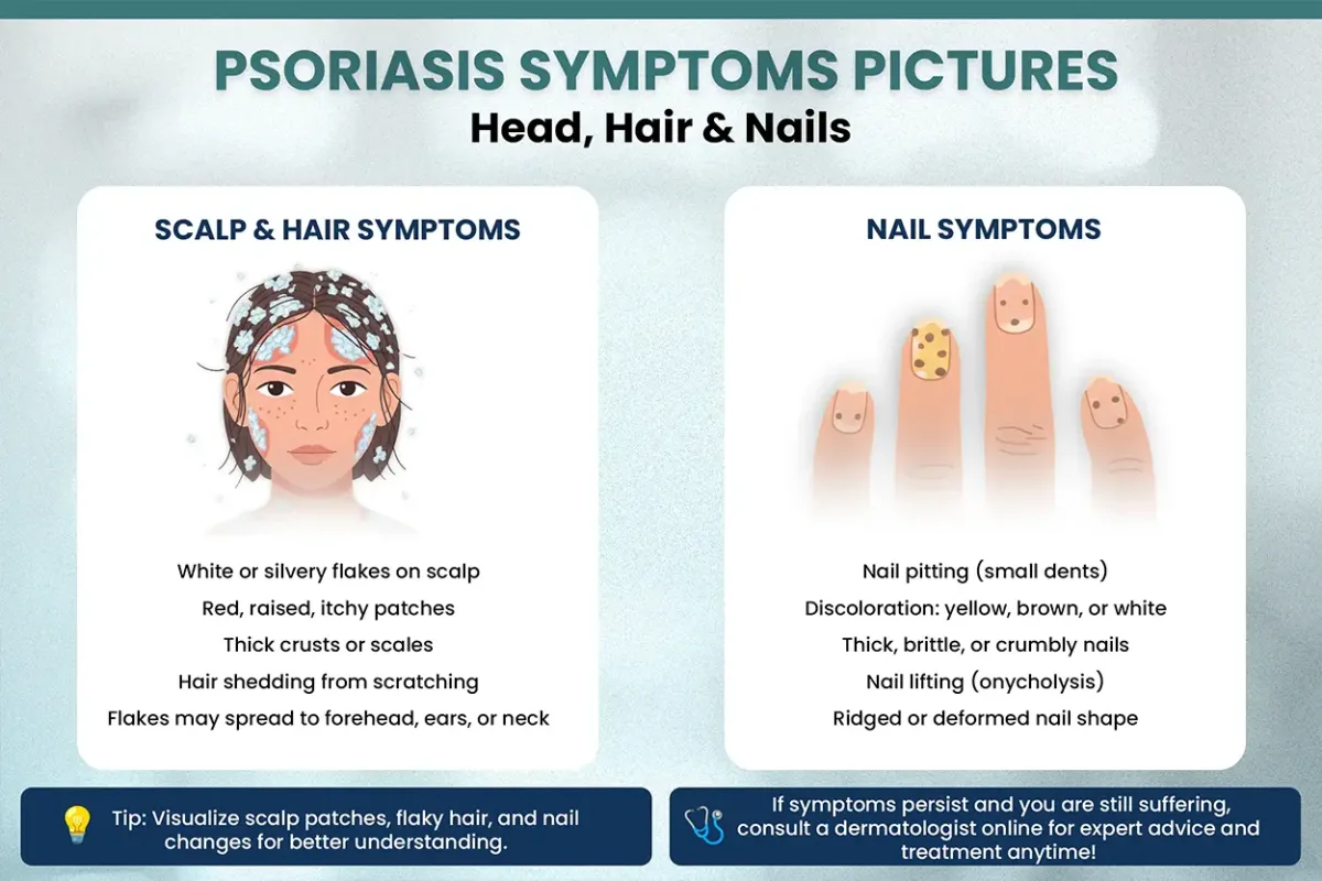Psoriasis Symptoms Pictures - Guide and Treatment By Neodermatologist