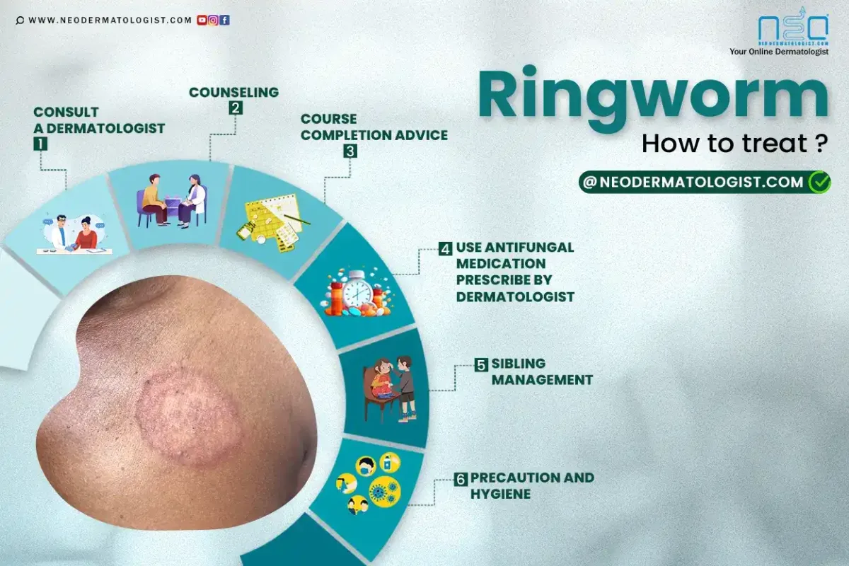 Know how to treat ringworm - Most important step to treat or cure a ringworm