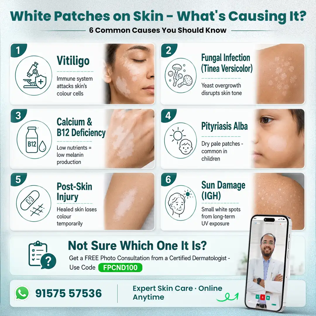 White Patches on Skin - What's Causing It? - Get the Right Diagnosis