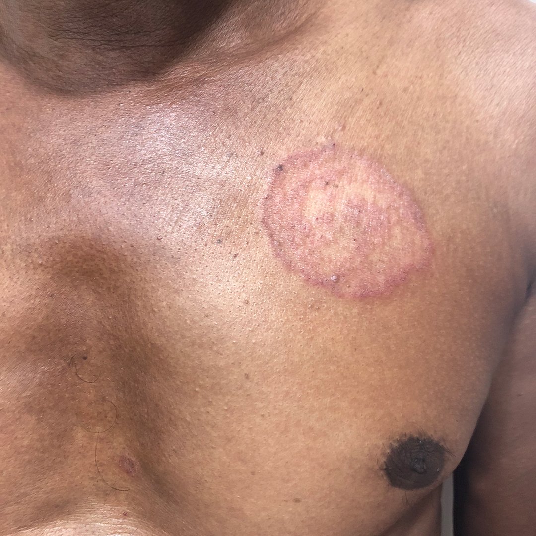 Before treatment with an online dermatologist, an image showing a circular ringworm fungal infection patch on the chest skin