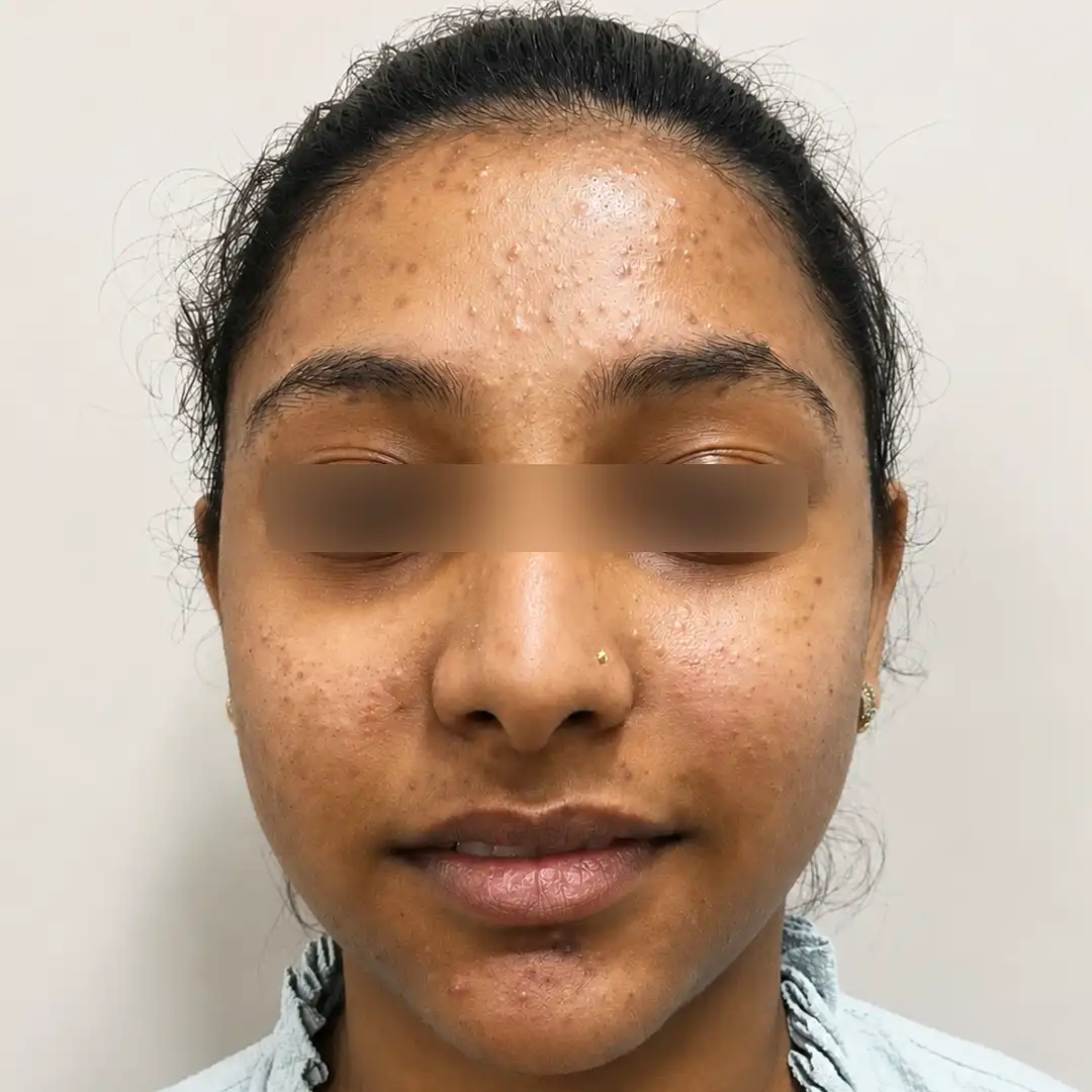 Before acne treatment with an online dermatologist, an image showing pimples, acne marks, and uneven facial skin texture