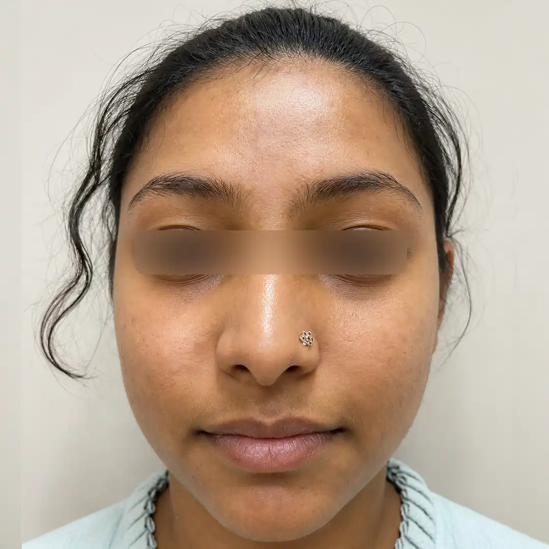 After acne treatment with an online dermatologist, the image shows clearer skin with reduced acne marks and smoother texture