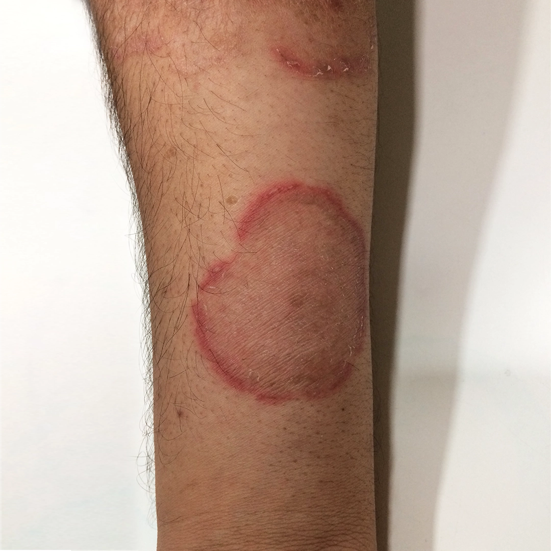 Severe ringworm infection before online consultation - Dad ka bada fungal infection (ringworm) with redness, itching, and circular rash on the hand