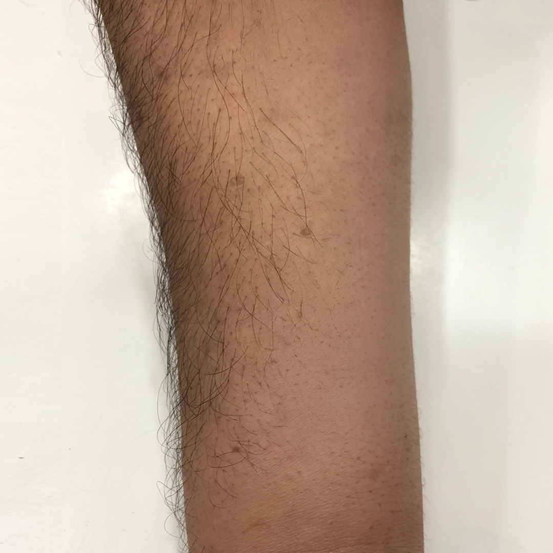 After online ringworm treatment result - Dad ka fungal infection (ringworm) completely cured with clear and healthy skin recovery