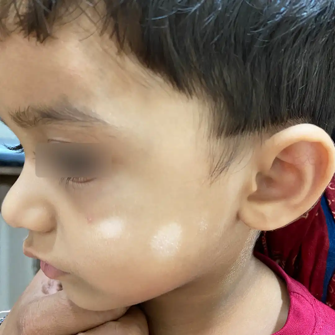 विटिलिगो उपचार से पहले - 7 वर्षीय बच्चे के बाएं गाल पर त्वचा रोग विशेषज्ञ द्वारा उपचार शुरू होने से पहले दिखाई देने वाला सफेद दाग (विटिलिगो)।