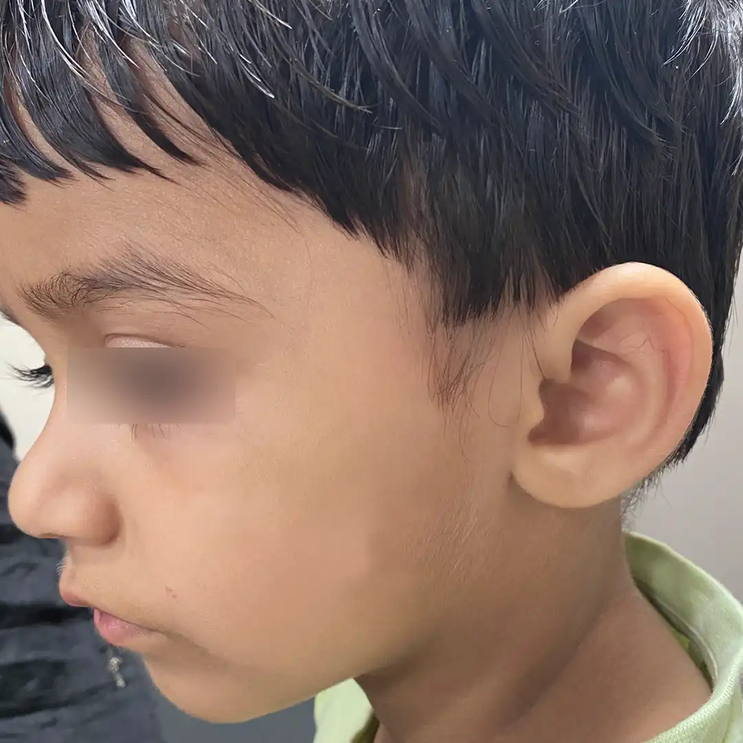 विटिलिगो उपचार के बाद - डॉ. रुचिर शाह द्वारा किए गए विटिलिगो उपचार के बाद बाएं गाल के सफेद दाग में स्पष्ट पुनः रंगत (Repigmentation) और उल्लेखनीय सुधार।