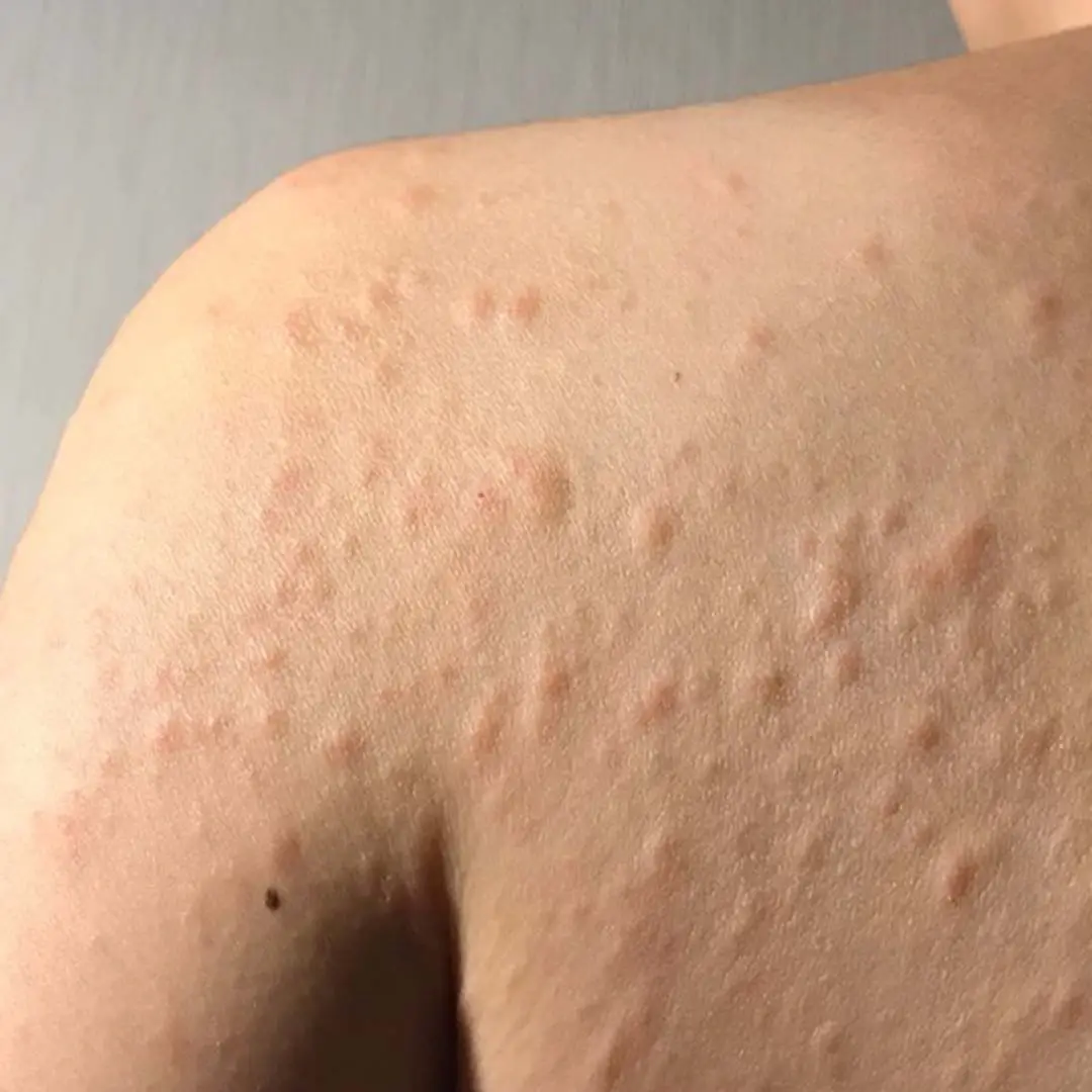 Before online urticaria treatment, male patient with multiple raised itchy hives and red wheals on shoulder and upper back