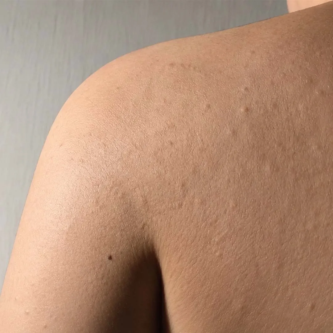 After online urticaria treatment, male patient showing clear skin with significant reduction in hives and raised wheals on shoulder and upper back
