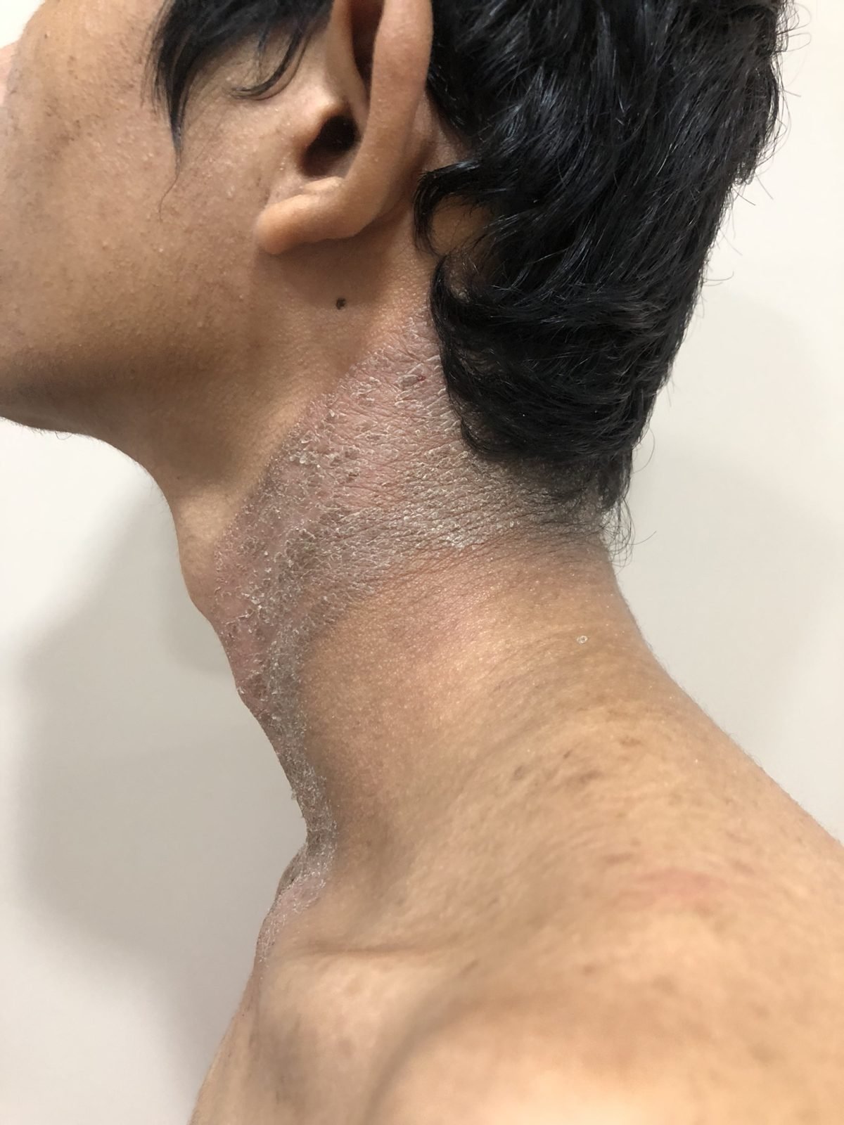 Before plaque psoriasis online treatment on the neck showing thick scaly patches, redness, and skin inflammation