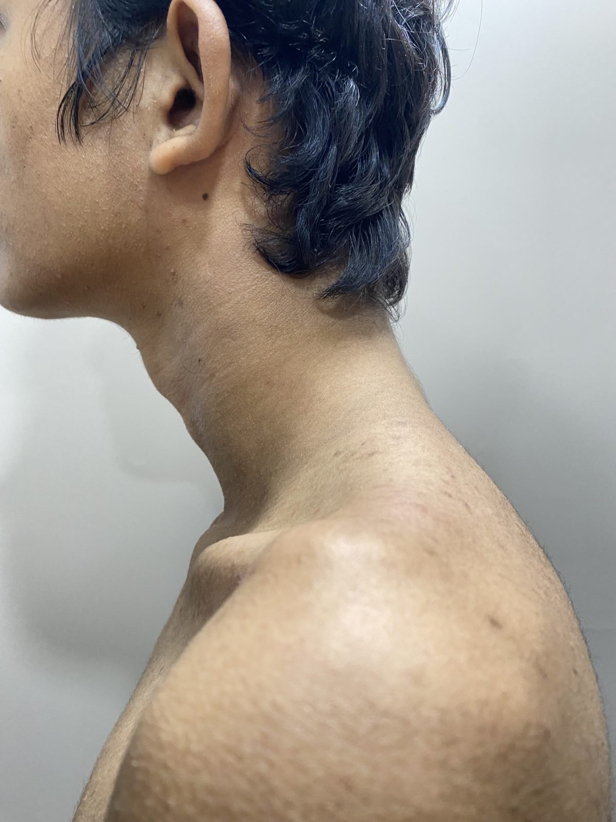 After plaque psoriasis online treatment on the neck showing clearer skin with reduced scaling and redness