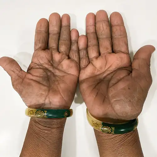 ऑनलाइन एक्जिमा उपचार के बाद दोनों हाथों की स्वस्थ त्वचा, एक्जिमा में स्पष्ट सुधार, कम पपड़ी, भरी हुई दरारें और डर्मेटोलॉजिस्ट के उपचार के बाद बेहतर रिकवरी।