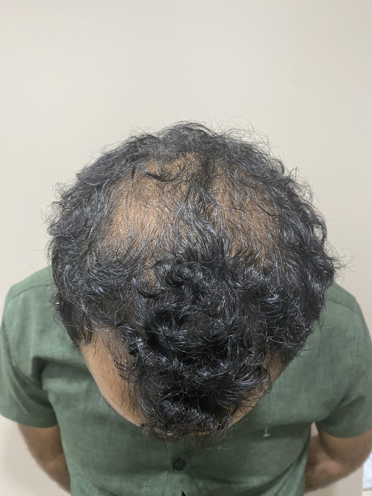 बालों के उपचार से पहले क्राउन एरिया में स्कैल्प दिखाई देने और बालों के पतले होने की तस्वीर।