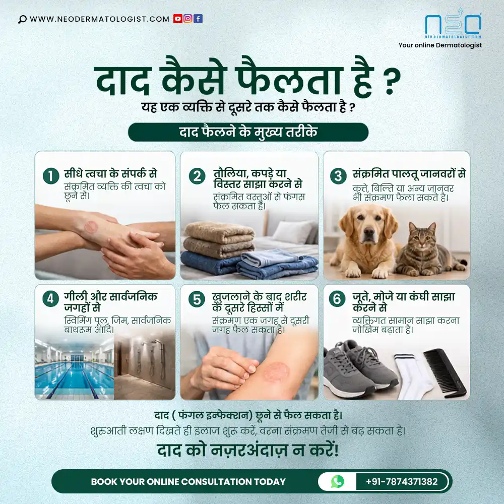 दाद कैसे फैलता है - व्यक्ति से व्यक्ति, संक्रमित वस्तुओं, पालतू जानवरों और सार्वजनिक जगहों से दाद फैलने के तरीके - टॉप सर्टिफाइड Neodermatologist डॉक्टरों की सलाह और इलाज