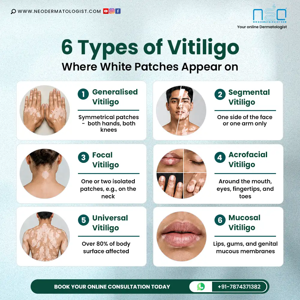 Look out the 6 Types of Vitiligo: Where White Patches Appear on the Body, Each type explain with the example - Neodermatologist guide
