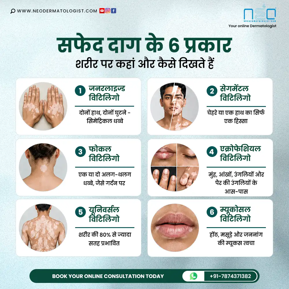 विटिलिगो (सफेद दाग - safed daad) के 6 प्रकारों के बारे में जानें: शरीर पर सफेद दाग कहाँ-कहाँ होते हैं और हर प्रकार को उदाहरण के साथ समझें - Neodermatologist गाइड।