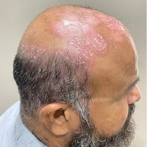 इलाज से पहले सिर की त्वचा और माथे पर सोरायसिस के कारण लालिमा और अधिक पपड़ी जमना