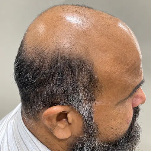 सोरायसिस के इलाज के बाद सिर की त्वचा और माथे की स्थिति, जिसमें पपड़ी और सूजन में कमी दिखाई देती है
