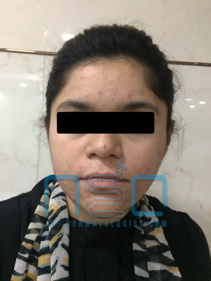 Severe Grade 3 pimples showing numerous inflamed, painful pustules and nodules on the face	