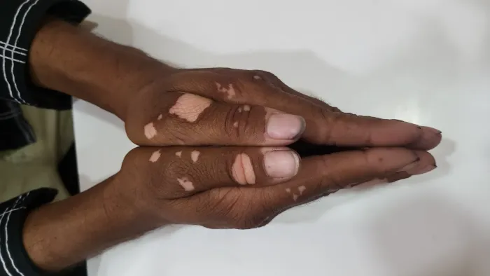
online dermatologist consultation , dermatologist consultation online , online dermatologist, best online dermatologist, skin care doctor near me , dermatologist , consult dermatologist online , online consult dermatologist best near me , dermatologist 