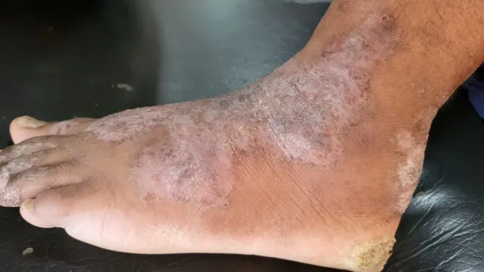 Fungal infection		