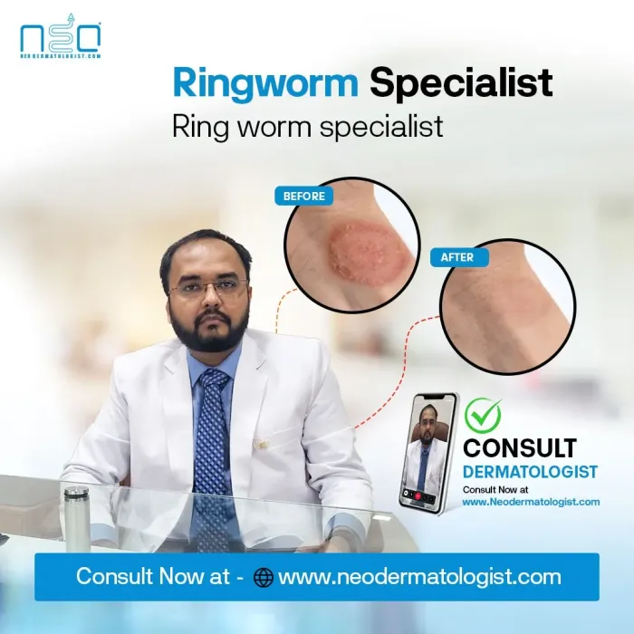 Ringworm specialist, Ring worm specialist