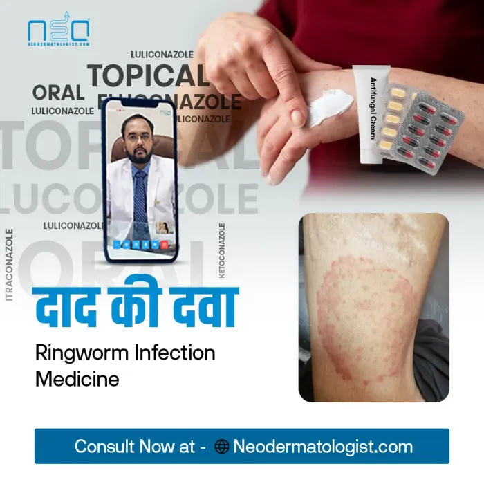 दाद की दवा , ringworm infection medicine 
