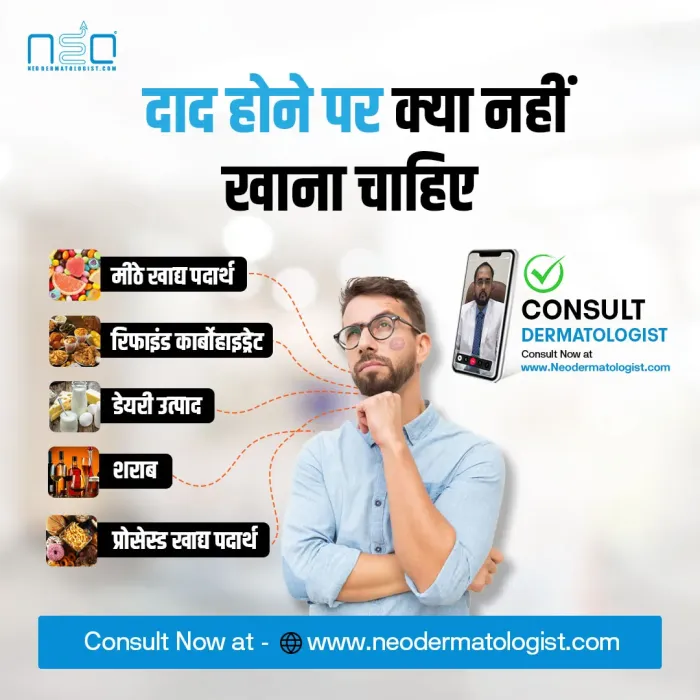 दाद होने पर क्या नहीं खाना चाहिए , दाद 
