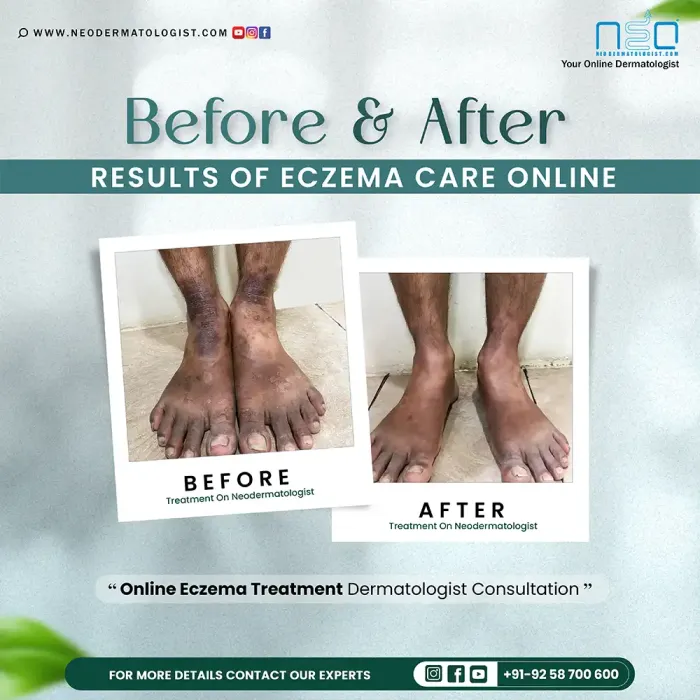 Eczema Treatment Online - Before and After results of eczema care online