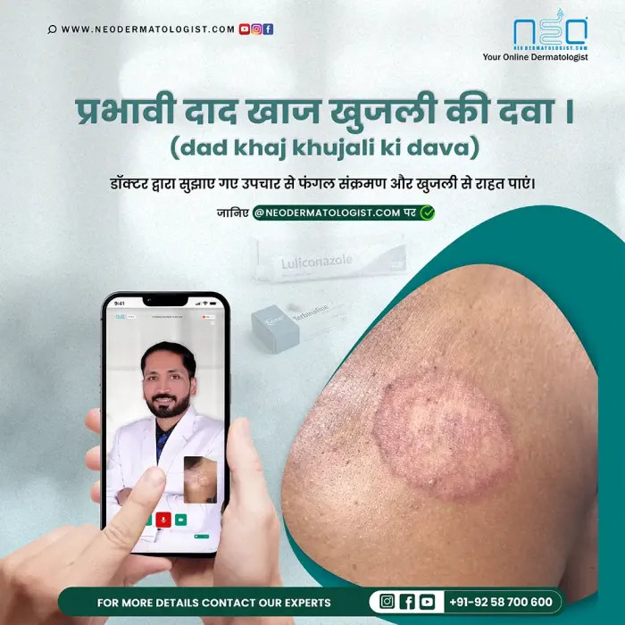 Ringworm Itching Medicine - Get Doctor-Recommended Treatment Online At Neodermatologist
