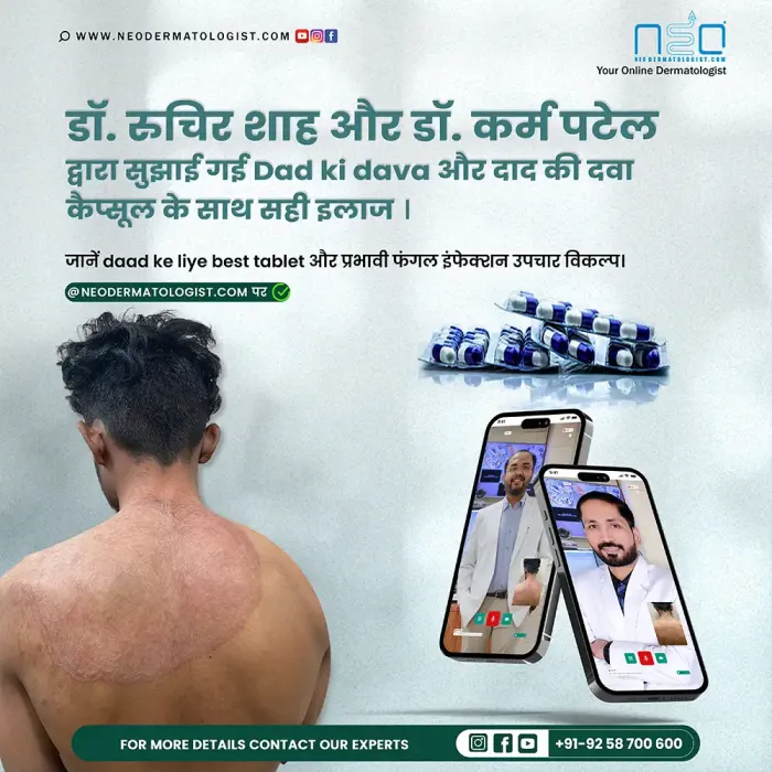 Correct treatment with ringworm medicine, ringworm medicine capsules recommended by Dr. Ruchir Shah and Dr. Karma Patel - Neodermatologist
