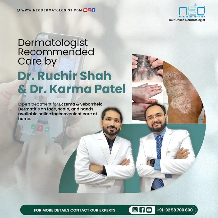 Expert treatment for Eczema & Seborrheic Dermatitis on face, scalp, and hands - available online for convenient care at home by Dr.Ruchir Shah & Dr.Karma Patel