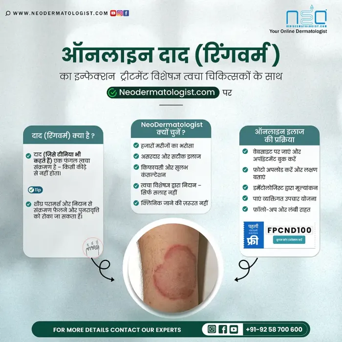 ऑनलाइन दाद (रिंगवर्म) का तुरंत इलाज - Neodermatologist  पर विशेषज्ञ से ट्रीटमेंट पाएं