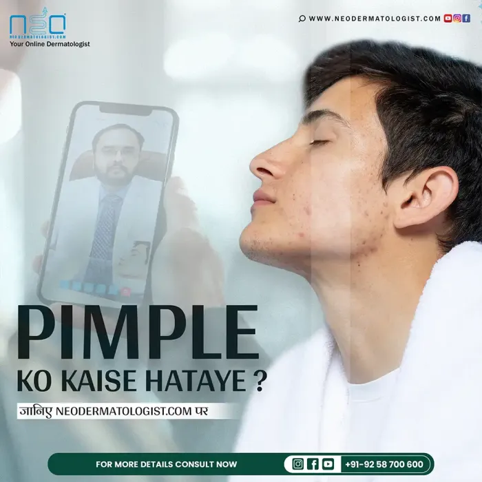Know how to remove a pimple - expert tips and treatment by Dr.Ruchir Shah at Neodermatologist