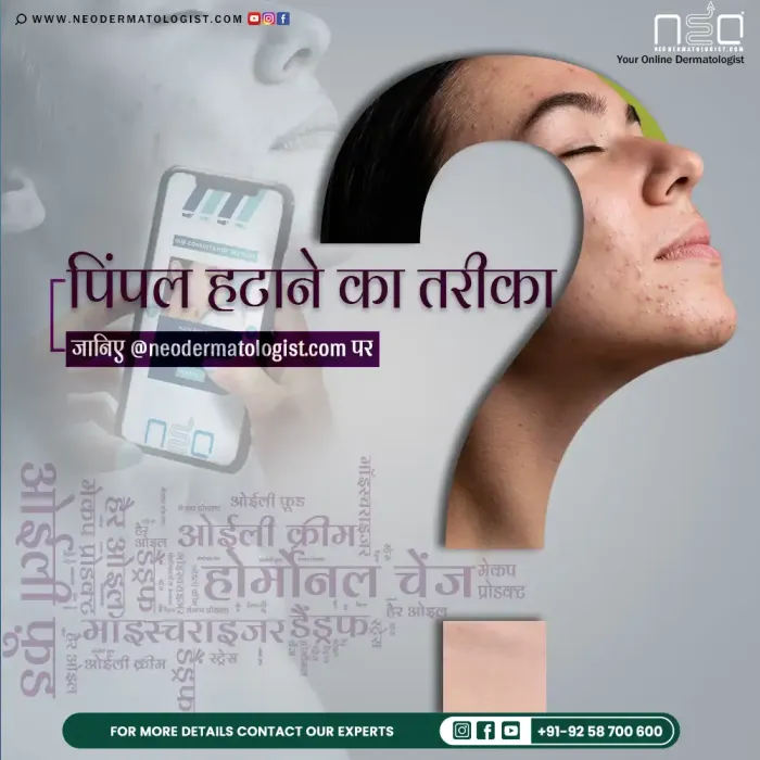 Know How To Remove Pimples - Dermatologist Recommended Guide and Treatment at Neodermatologist.com