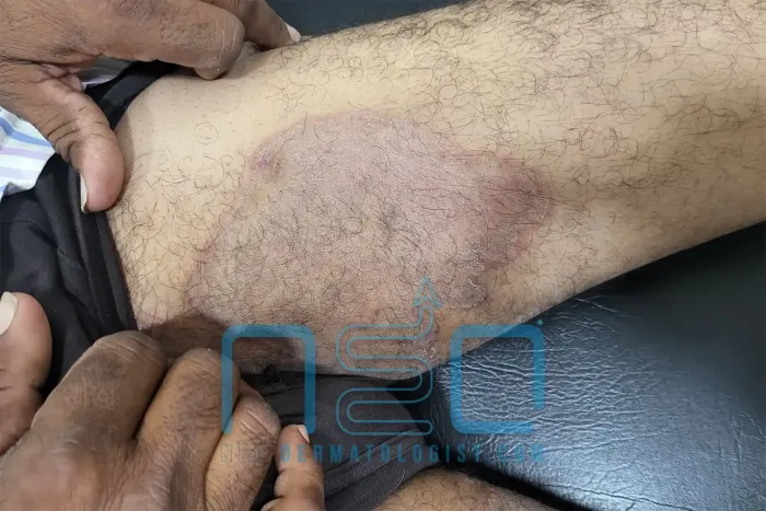 ऑनलाइन त्वचाविज्ञान परामर्श के दौरान किए गए मूल्यांकन में, जांघ के भीतरी भाग पर कमर के पास एक बड़ा, स्पष्ट रूप से परिभाषित लाल-भूरा फंगल रैश दिखाई दे रहा है, जो जॉक इच (टिनिया क्रूरिस) के अनुरूप है।