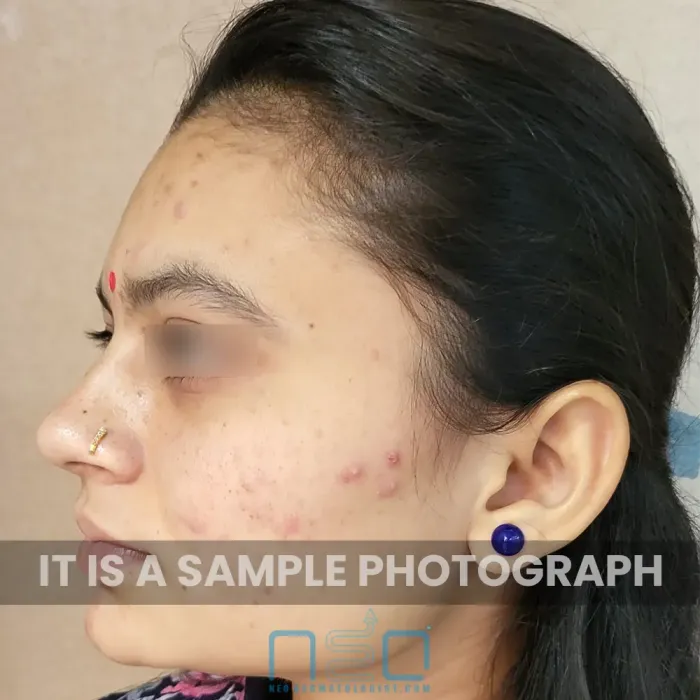 चेहरे के गालों पर सूजन वाले लाल दानों और ठीक हो रहे मुहांसों के धब्बों के साथ मध्यम ग्रेड 2 मुहांसों का क्लोज-अप साइड प्रोफाइल दिखाया गया है।
