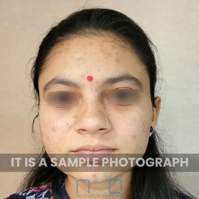 एक महिला के चेहरे का सामने से लिया गया दृश्य जिसमें मध्यम श्रेणी 2 के मुंहासे हैं, जिनमें कई लाल सूजन वाले मुंहासे के घाव और गालों और माथे पर बिखरे हुए ब्लैकहेड्स दिखाई दे रहे हैं।
