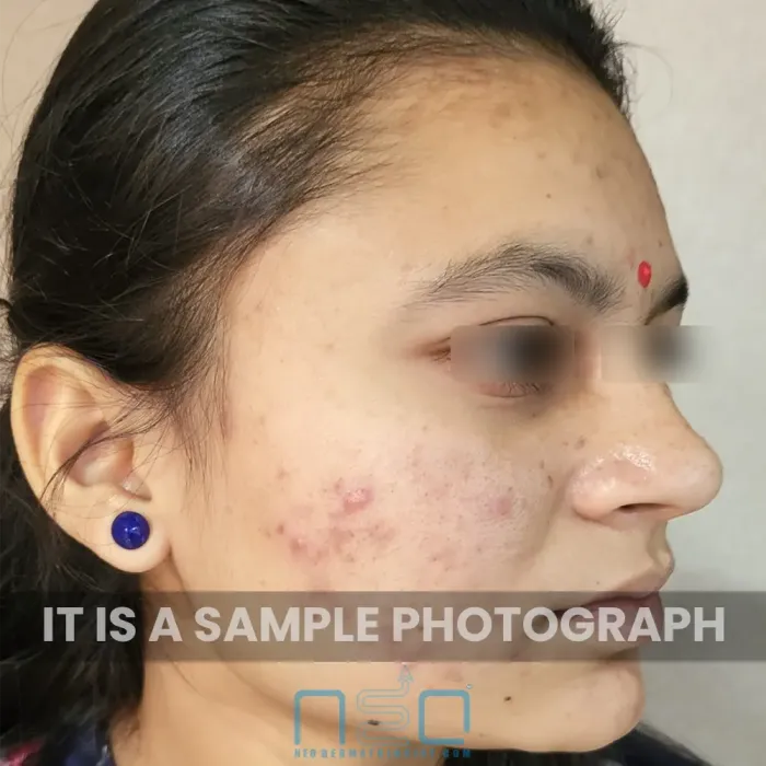 एक महिला के चेहरे का पार्श्व दृश्य जिसमें मध्यम श्रेणी 2 के मुंहासे दिखाई दे रहे हैं, जिनमें लाल, सूजे हुए दाने और गाल पर मुंहासों के बाद के निशान मौजूद हैं।