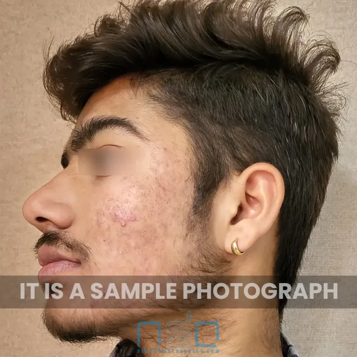 उपचार से पहले मुंहासों के निशान और सूजन के बाद होने वाले हाइपरपिगमेंटेशन को दर्शाने वाला दाहिना दृश्य।