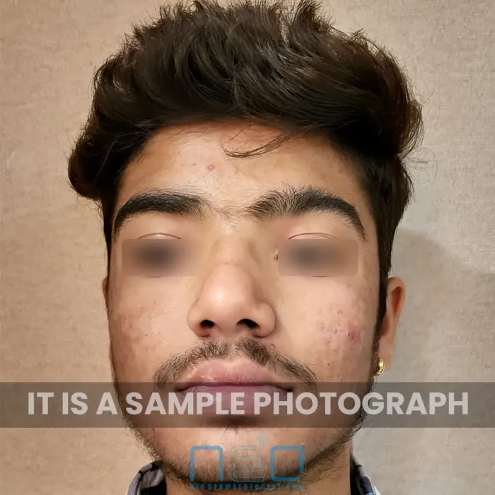 त्वचा संबंधी उपचार से पहले चेहरे पर मुंहासों के निशान और उपचार के बाद के धब्बे सामने से दिखाई दे रहे हैं।
