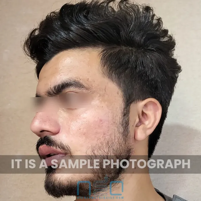 त्वचा विशेषज्ञ द्वारा इलाज किए गए एक पुरुष रोगी का दाहिना भाग, जिसमें मुँहासे के निशान और त्वचा पर धब्बे दिखाई दे रहे हैं।
