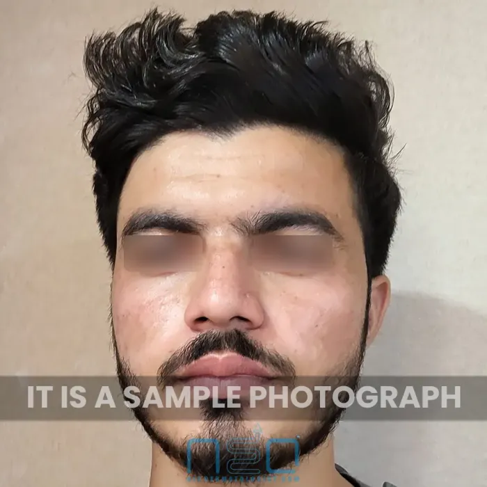 त्वचा विशेषज्ञ द्वारा मुंहासों के उपचार के बाद मुंहासों के निशान और त्वचा की बनावट में सुधार दर्शाने वाले एक पुरुष रोगी का सामने से लिया गया दृश्य।
