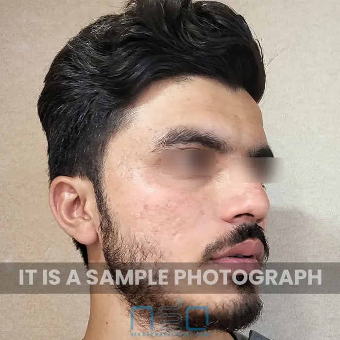 एक पुरुष रोगी का बायां साइड प्रोफाइल जिसमें पेशेवर मुंहासे के इलाज के बाद मुंहासे के निशान और उपचार के बाद के धब्बे दिखाई दे रहे हैं।