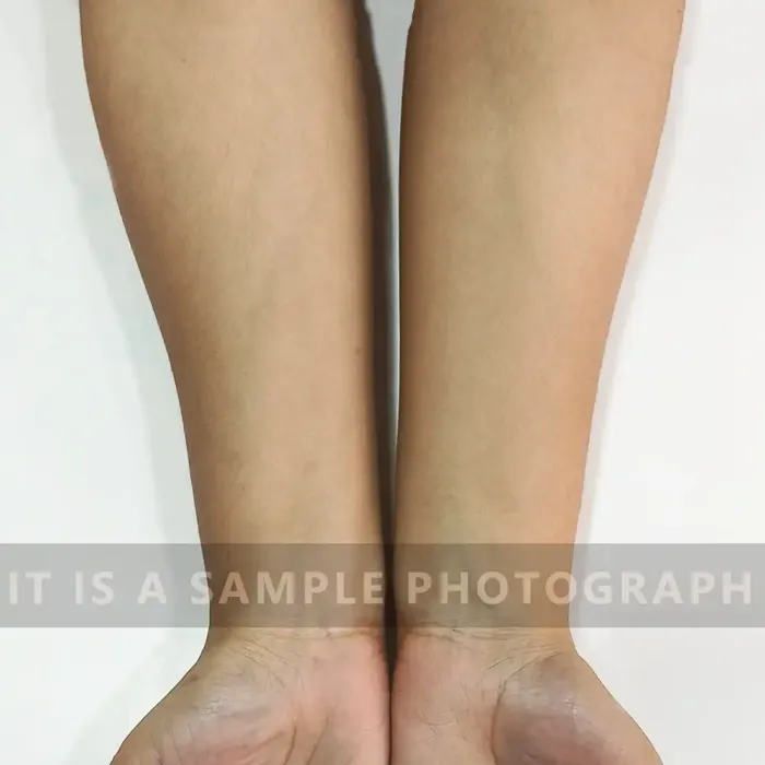 Sample Image Of Front Hand After Successful Scabies Treatment - Neodermatologist