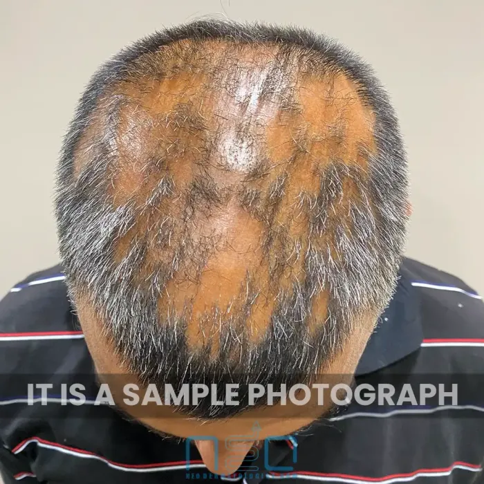 Top view of scalp showing extensive patchy hair loss and reduced hair density on crown region, clinical photograph from Neodermatologist