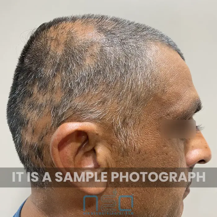 Side view of scalp showing patchy hair loss and thinning areas in an adult male patient, clinical image by Neodermatologist