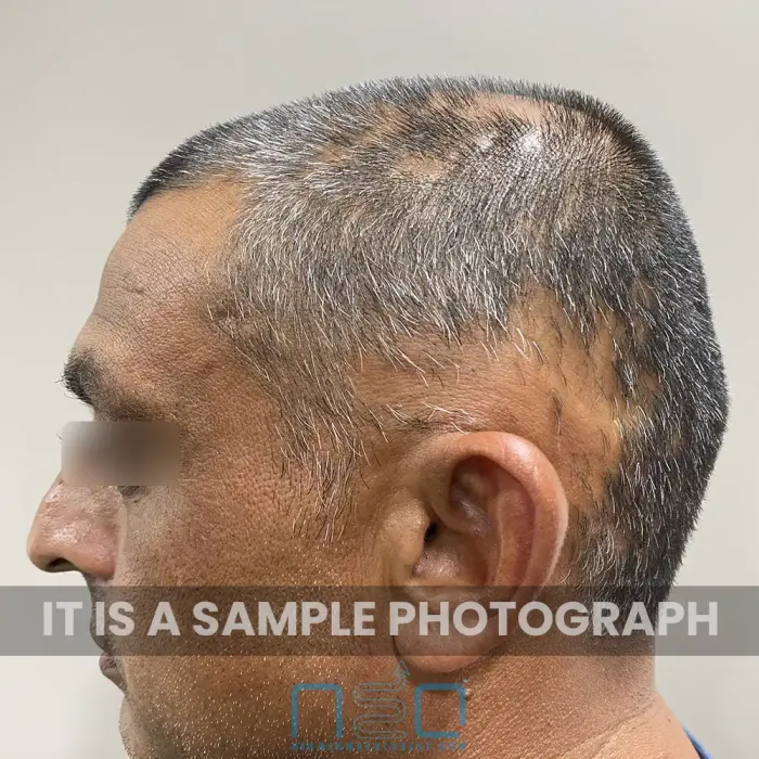Left  side profile of scalp with visible hair thinning and patchy alopecia areas, documented by the Neodermatologist dermatology team